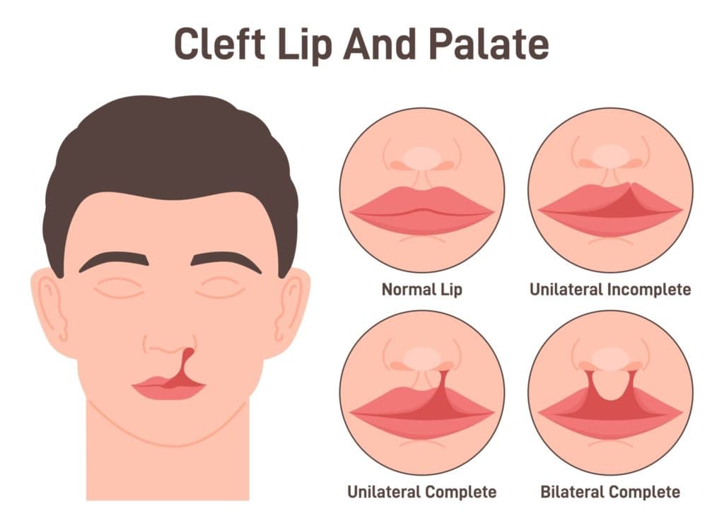 Cleft lip and palate